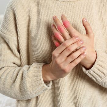 Ghid medical despre gută – de la diagnostic la îngrijirea zilnică Woman,With,Joint,Inflammation,Indoors,,Closeup.,Red,Areas,On,Fingers